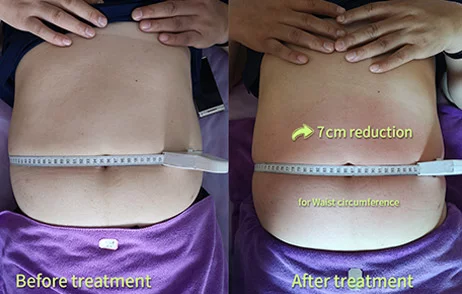 Antes y después del tratamiento-1