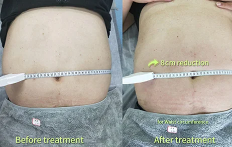 Antes y después del tratamiento-2