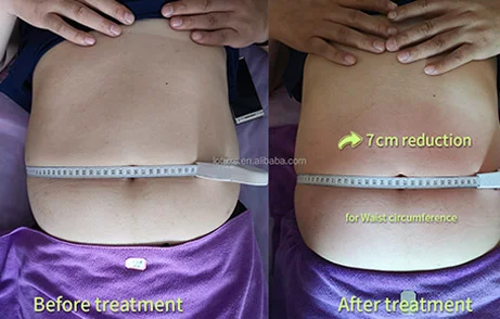 Antes y después del tratamiento-3
