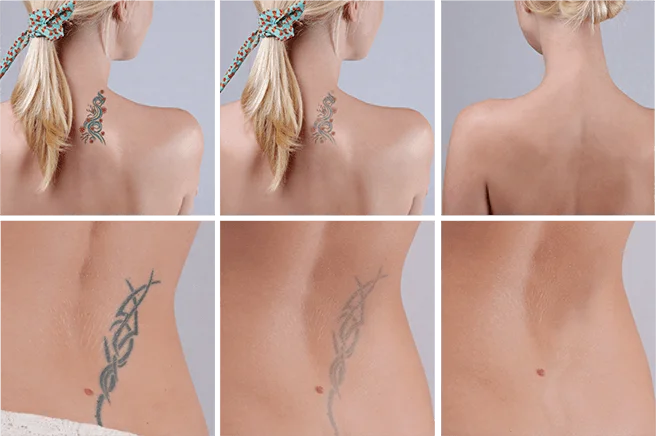 Лазерное удаление татуировок DualPico