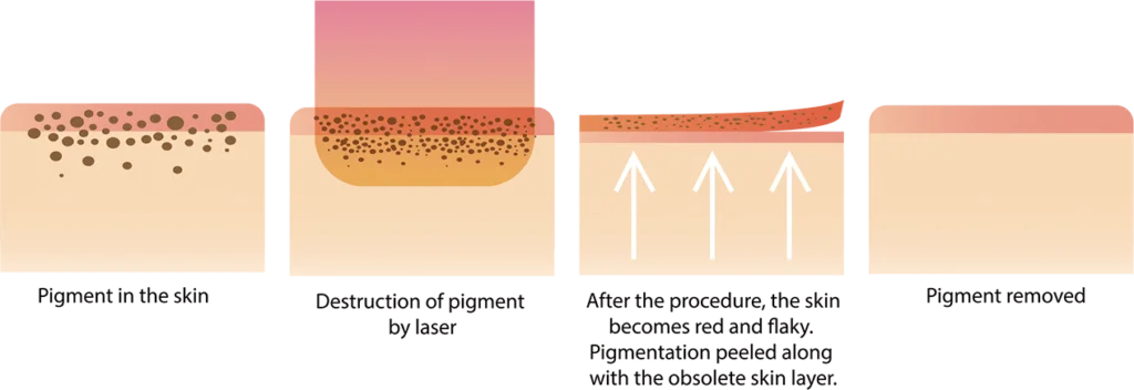 Как работает пикосекундная лазерная система DualPico