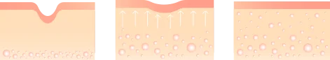 Wirkungsmechanismus des RF-Instruments