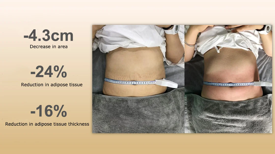 Riduzione del grasso