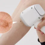 Dilemme des taupes et des poils : l'épilation au laser est-elle sûre ?