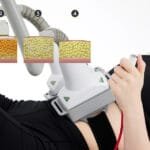 Laser-Lipolyse-Ergebnisse: Was passiert mit Ihren Fettzellen?