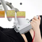 Risultati della lipolisi laser: Cosa succede alle cellule grasse?