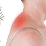 Esculpe tu cuello, deshazte de la joroba: Descubra la lipólisis láser