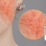 Безупречная кожа начинается здесь: Pico Laser для восстановления капилляров