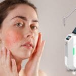ピコ・レーザー技術で酒さの悪化を最小限に抑える