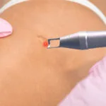 Esculpir una piel perfecta: El láser de picosegundos frente a las cicatrices queloides