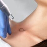 Tattoo im Handumdrehen verschwunden: Verblassende Tinte mit Pico Laser