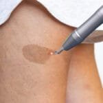 Pico Laser-Lösung: Muttermale verblassen lassen, Selbstvertrauen aufbauen