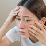 Как уменьшить покраснение после лазерной терапии