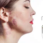 Apagar o vermelho: como o Laser Pico trata as manchas de vinho do Porto
