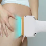 Esculpa a sua silhueta: Lipólise a laser para coxas