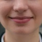 Die Lippenfältchen verschwinden: Ein Radiofrequenz-Makeover