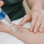 Kann der Pico-Laser eine Tätowierung vollständig entfernen?