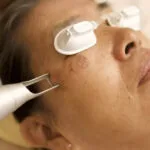 Erbium vs. Pico Laser no tratamento da hiperpigmentação