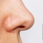 Умный способ избавиться от угрей: Pico Laser объясняет