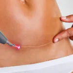 O laser de picossegundos pode realmente minimizar as cicatrizes cirúrgicas?