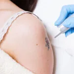 Quanto tempo bisogna aspettare tra una sessione di rimozione del tatuaggio laser e l'altra?
