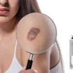 Cicatrices abultadas, ¡desaparece! Cómo el láser Pico alisa las cicatrices hipertróficas