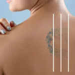 Regret de l'encre ? Comment le Pico Laser efface le passé, rapidement !