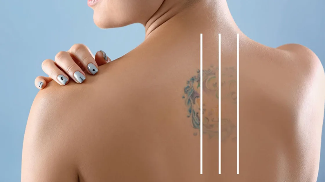 Ink Regret? How Pico Laser Clears the Past, Fast! - Rheinlaser ✔️