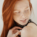 How Pico Laser Delivers Visible Results to Treat Birthmarks and Dark Spots