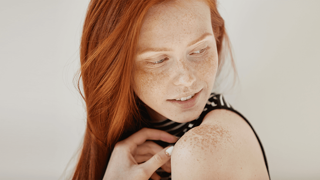 How Pico Laser Delivers Visible Results to Treat Birthmarks and Dark Spots