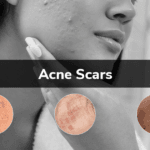 Laser Therapy for Acne Scars and Skin Texture