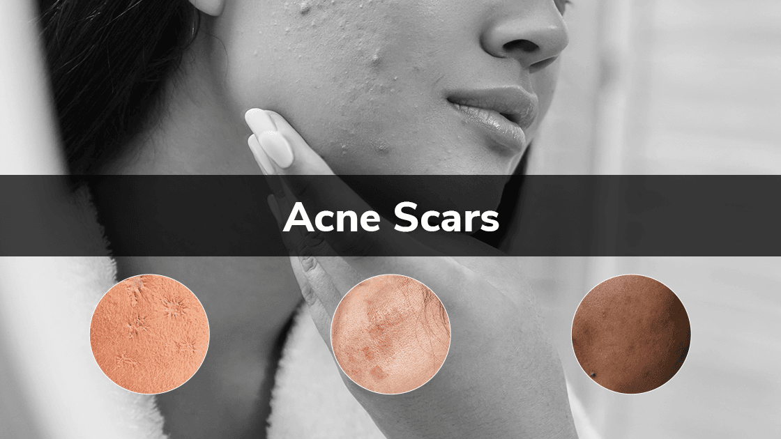 Laser Therapy for Acne Scars and Skin Texture