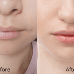 Laser Lip Rejuvenation for Natural, Smooth Lips