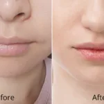 Laser Lip Rejuvenation for Natural, Smooth Lips