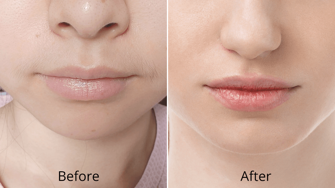 Laser Lip Rejuvenation for Natural, Smooth Lips