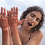 Pico Laser for Sun Spots: Supporting Hand and Arm Skin Rejuvenation