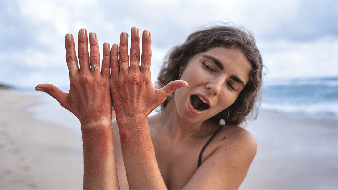 Pico Laser for Sun Spots: Supporting Hand and Arm Skin Rejuvenation