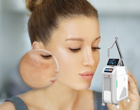 Tratamentos a laser para o melasma