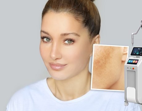 Laser Treatment