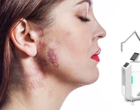 Laser para manchas de vinho do Porto