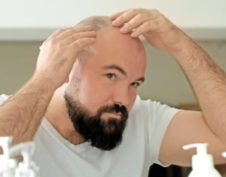 Лазерная эпиляция для лысой головы
