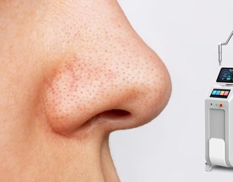 Pico Laser для лечения угрей