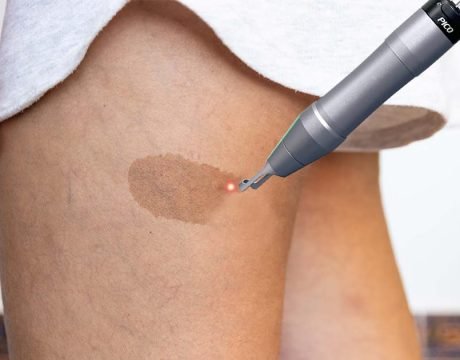 Пикосекундные лазеры для лечения родимых пятен