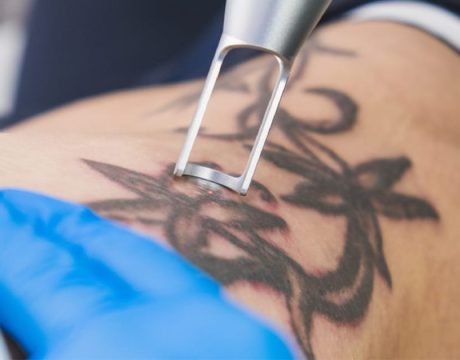 Laer Tattoo Removal