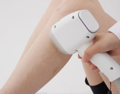 Лазерная эпиляция для клубничных ног