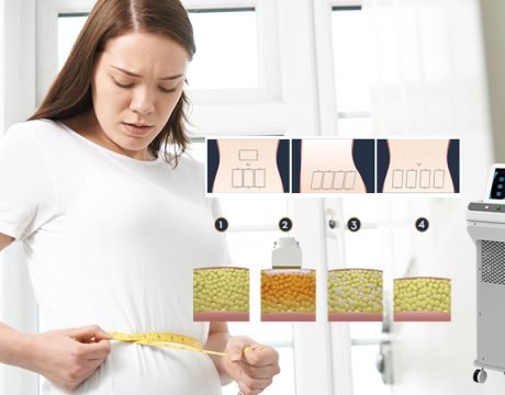 Laser Lipo